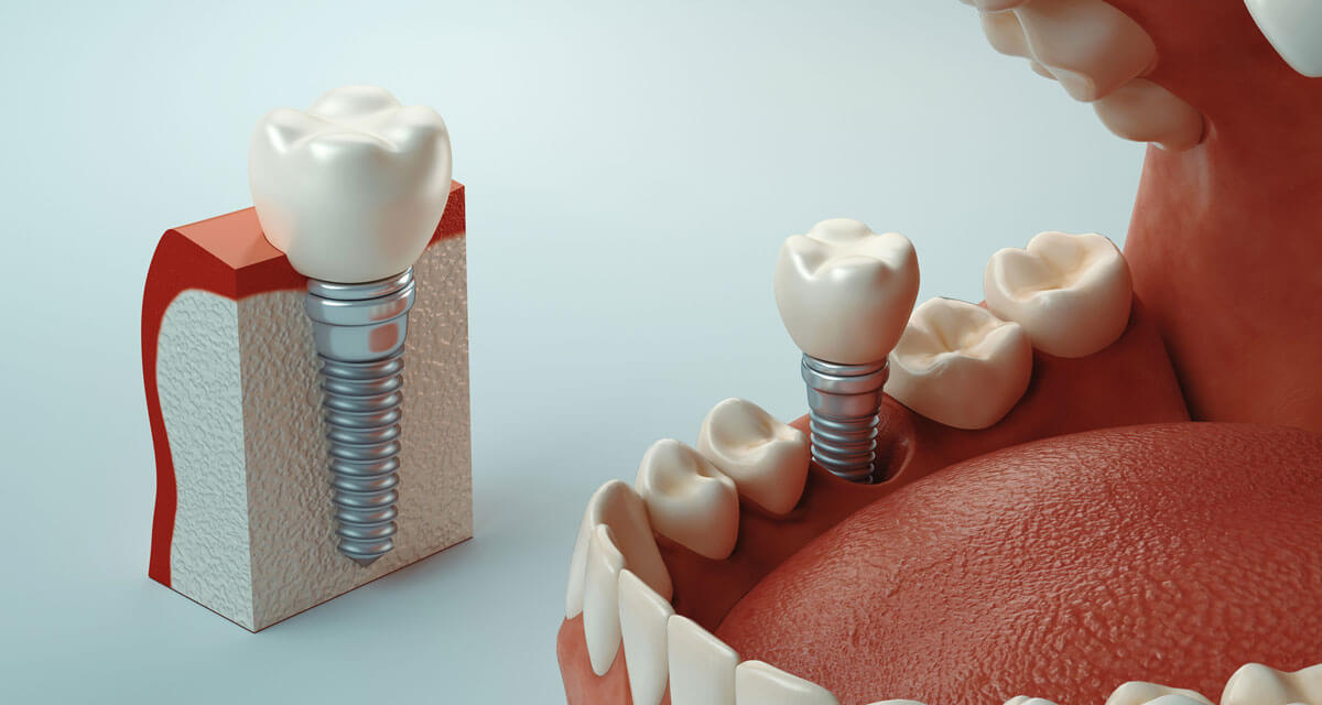 dental implant example