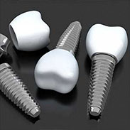 Dental Implants on Staten Island