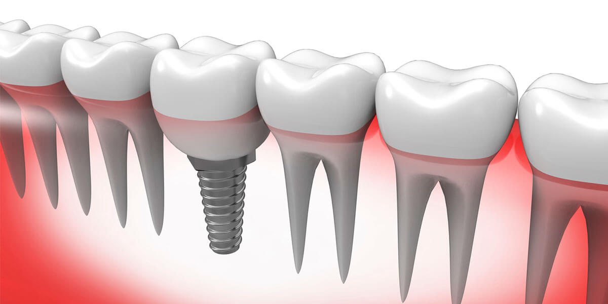 Single Dental Implants on Staten Island, NY